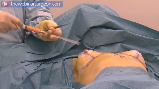 Fat Grafting to Upper Breast, J Frame