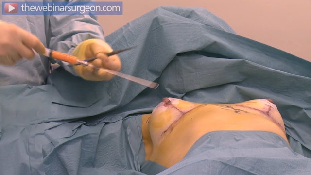 Fat Grafting to Upper Breast, J Frame