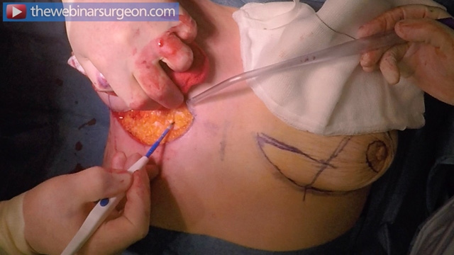 Superior Pedicle Mastopexy and Fat Grafting