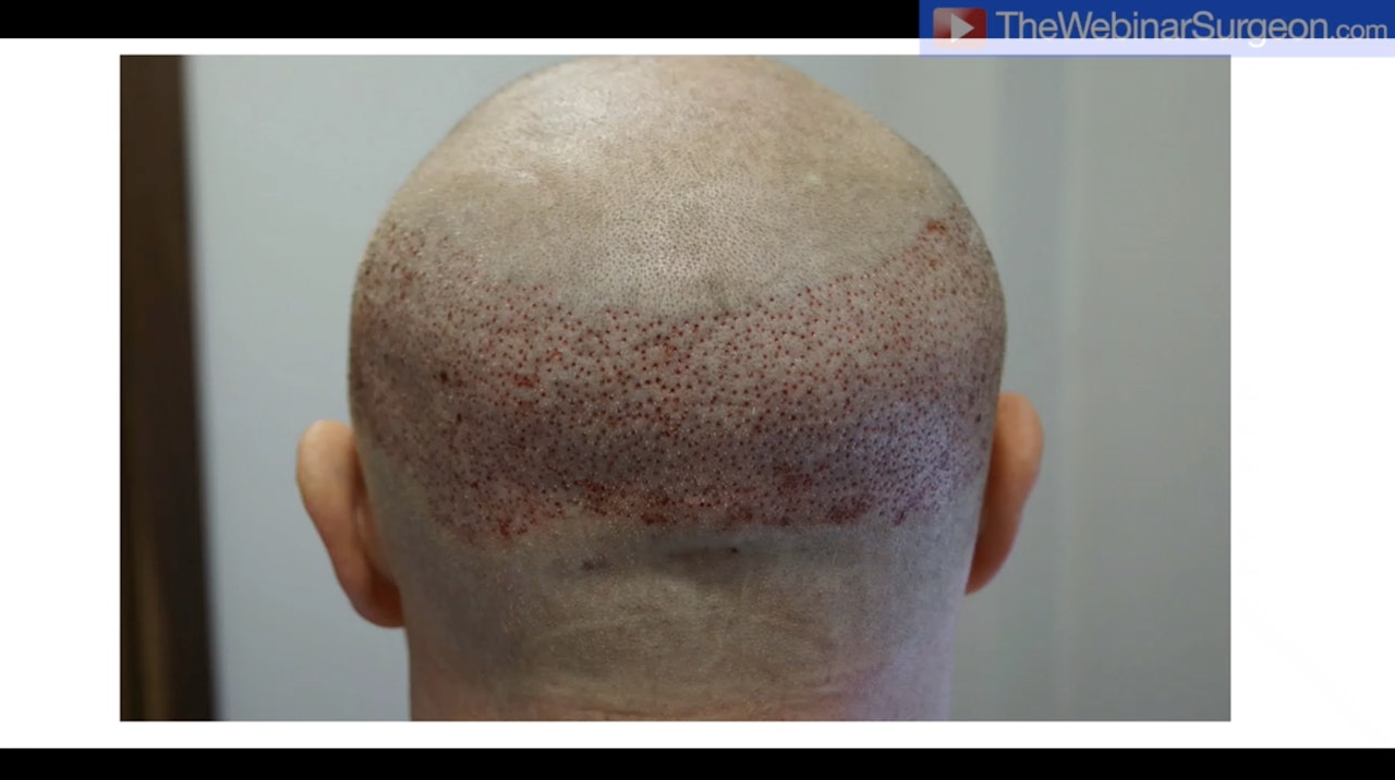 Current Hair Transplant Techniques, Greg Williams
