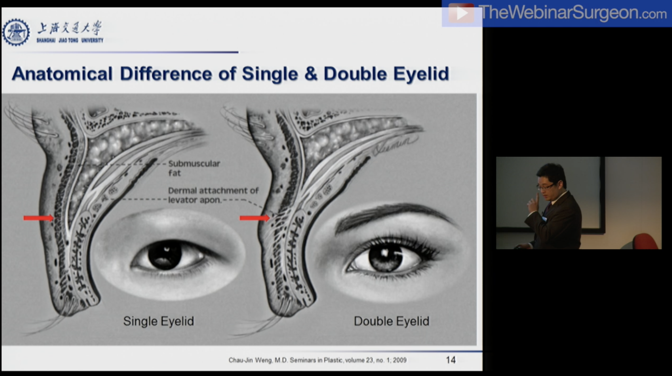 Asian Upper Blepharoplasty, A Chiang