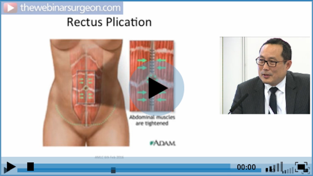 Abdominoplasty