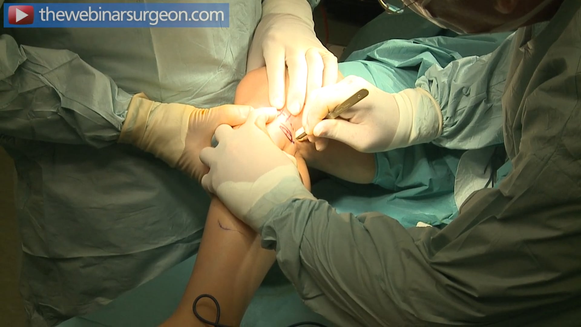 Sub-Fascial Calf Augmentation, J Frame