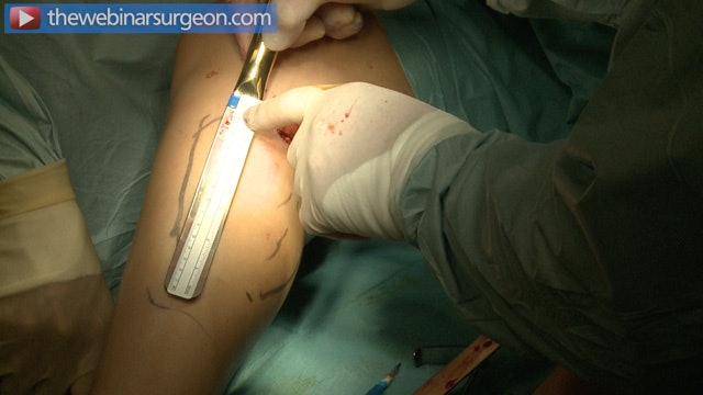 Body Contour Surgery: Learn Brazilian Techniques