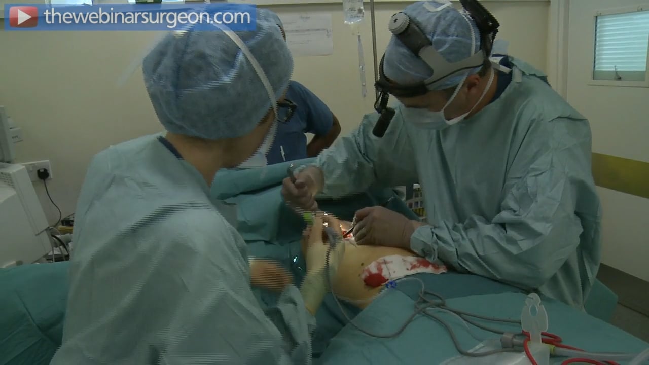 Breast Augmentation Mastopexy, Garrick Georgeu