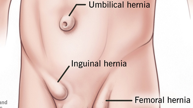 Heal Your Hernia from the Inside Out Without Surgery