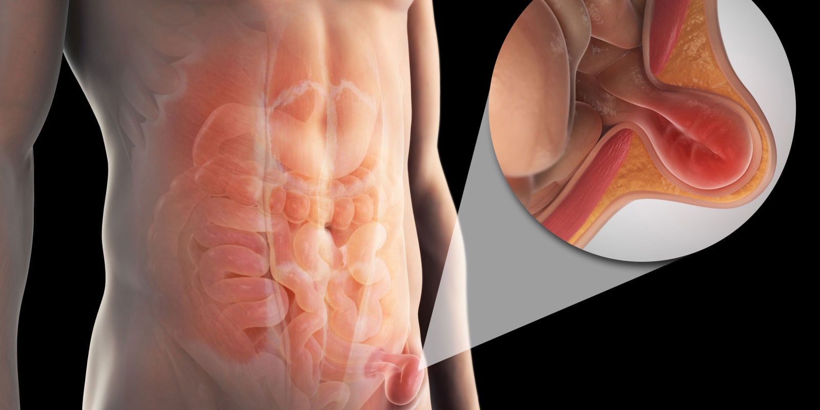 Heal Your Hernia from the Inside Out Without Surgery