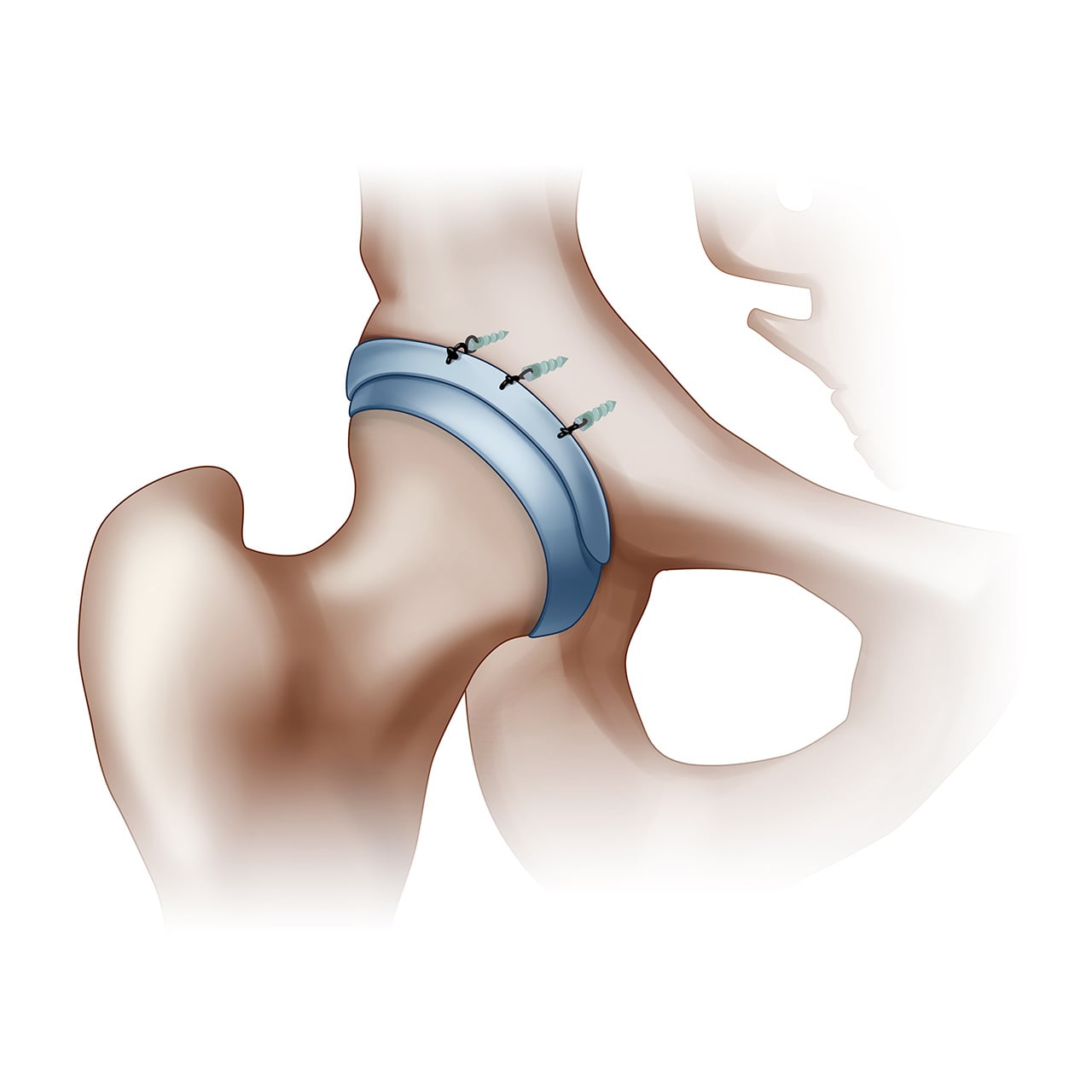 Heal Your Hips - Avoid Surgery with Corrective Exercise for FAI