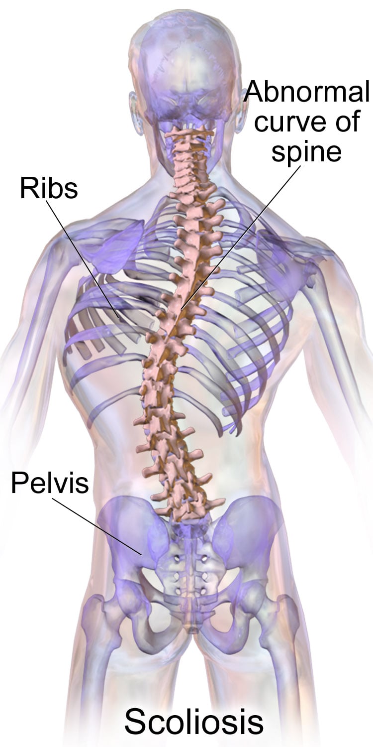 Unwinding Scoliosis