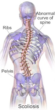 Unwinding Scoliosis