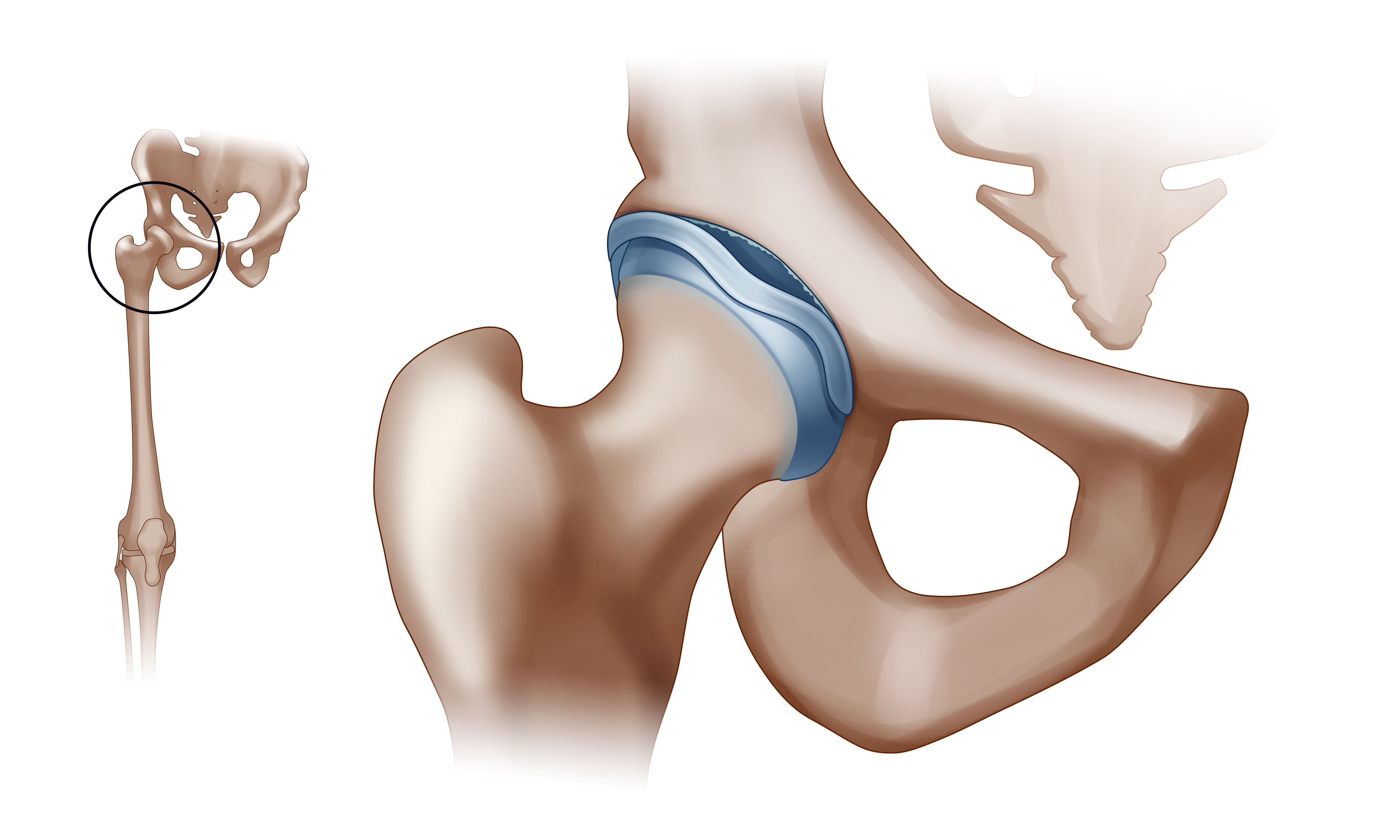 Heal Your Hips - Avoid Surgery with Corrective Exercise